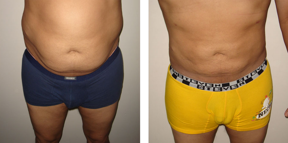 Combien Coûte Une Liposuccion? - VotreSante.Club 3 01-liposuccion-05