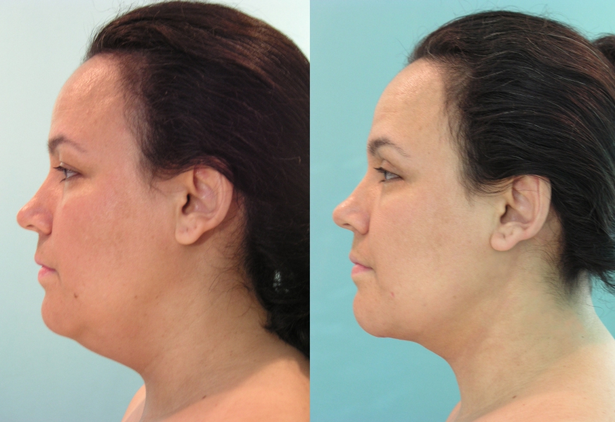 Combien Coûte Une Liposuccion? - VotreSante.Club 4 01-liposuccion-06