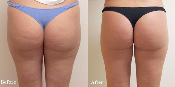 Velashape Ça Fonctionne? Qui est, Avant et Après, le Prix et la Révision 2 Avant-et-après-Velashape
