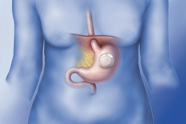 Gastrique ballon en Vaut la peine? 6 votresante.club votresante.club balao gastrico1