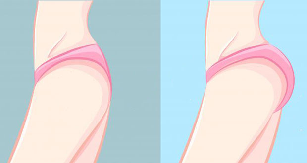 Tout au Sujet des Implants de Silicone dans les Fesses (Gluteoplasty) 2 votresante.club votresante.club implante siliconte