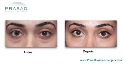 L'acide hyaluronique pour les cernes sous les yeux - Comment ça marche, les Risques, Avant et Après les Soins, et 1 votresante.club votresante.club olheira1