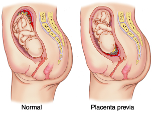Placenta praevia - c'est Quoi, les Types et les Soins 1 votresante.club votresante.club placenta previa