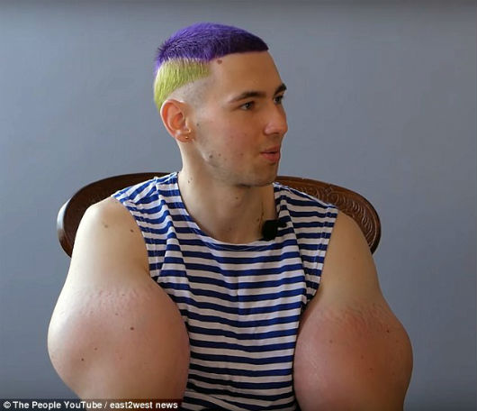 Les russes qui se sont Injectés de Synthol Pour Gonfler vos Bras, vous Pourriez Avoir à être amputé pour eux 9 votresante.club votresante.club tereshin3