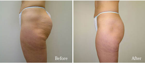 Velashape Ça Fonctionne? Qui est, Avant et Après, le Prix et la Révision 1 Velashape avant et après